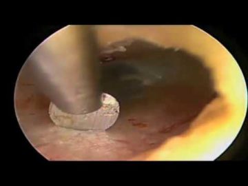 Cirugía endoscópica del oído: Técnica Endoscópica reconstrucción de cadena osicular