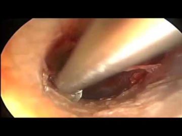 Cirugía endoscópica del oído: Timpanoplastia endoscopica