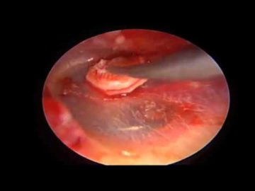 Cirugía endoscópica del oído: Timpanoplastia tecnica MARIPOSA