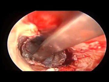 Cirugía endoscópica del oído: Maleoestapedo