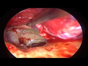 Cirugía endoscópica del oído: MALEOESTAP