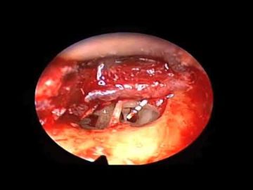 Cirugía endoscópica del oído: Estapedotomia